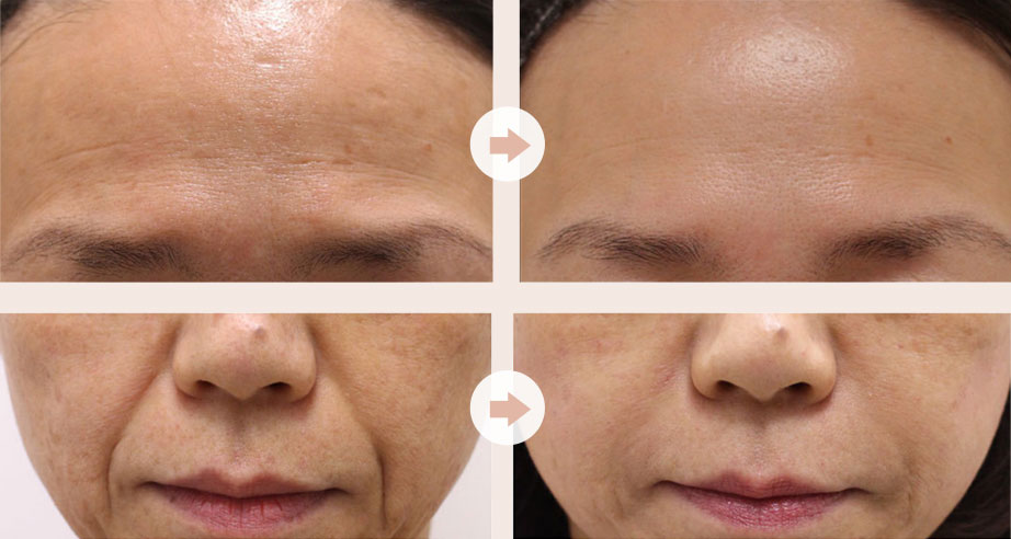 通过干细胞静脉回输，与皮肤靶向注射相结合