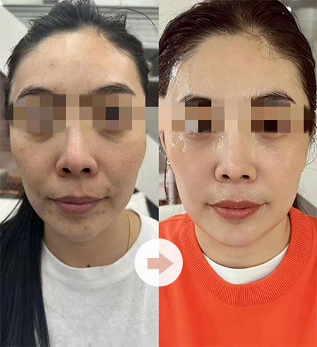 持续治疗后，患者皮肤状态得到显著提升